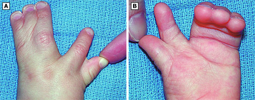 优贝贝!apert综合征是什么"同甘共苦"-第1张图片-途临网