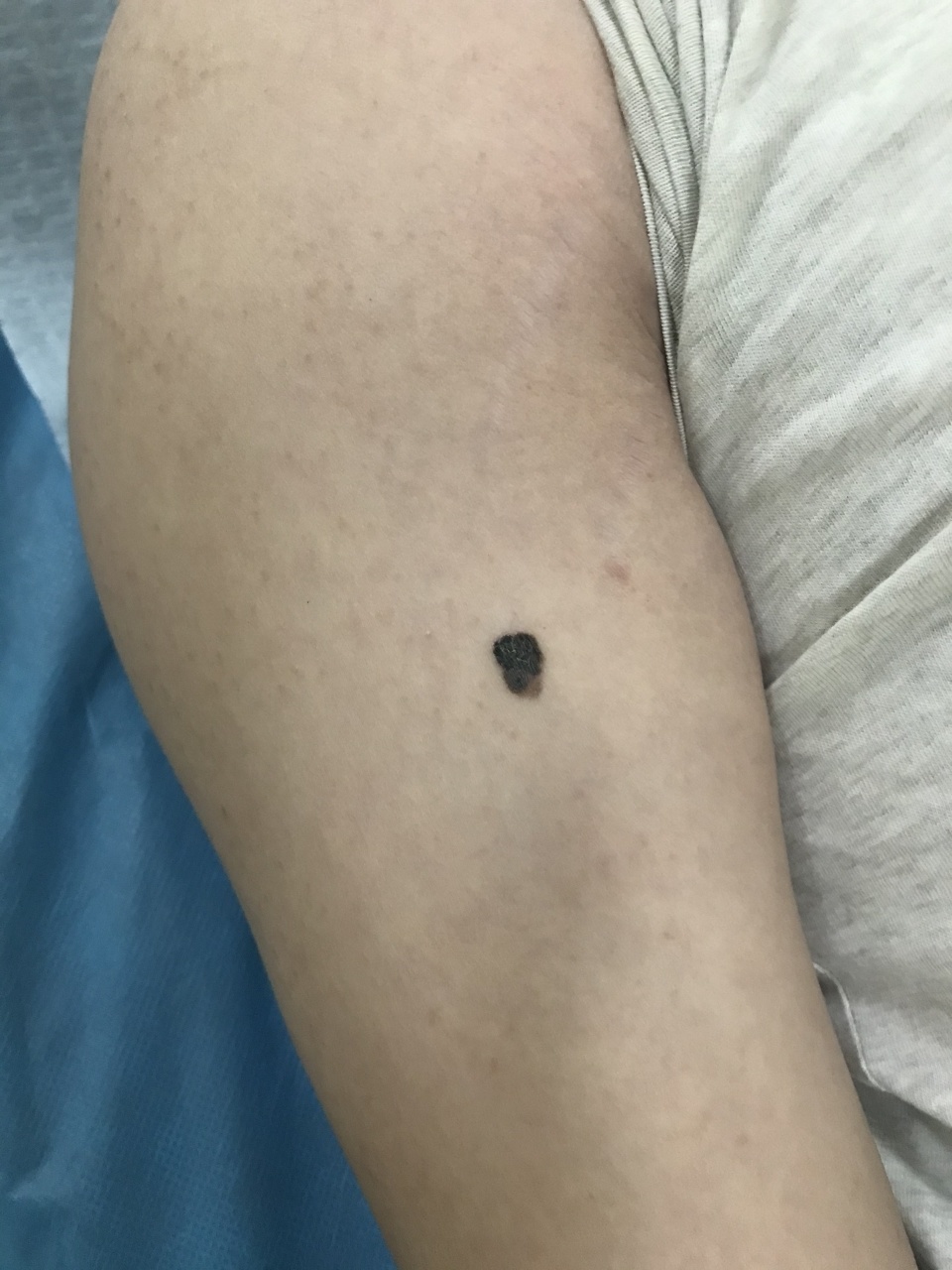 好声音亚军张恒远因黑色素瘤离去,不少年轻人慌忙赶去皮肤科:"快帮我