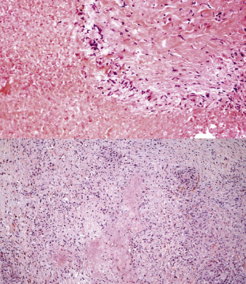 杨永峰教授:以肝损伤为主要表现的肉芽肿性疾病-腾讯新闻