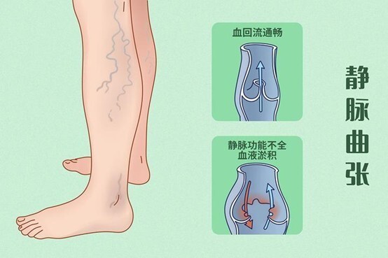 腿上出现弯弯曲曲的‘蚯蚓’和红血丝？这背后的秘密你知道吗