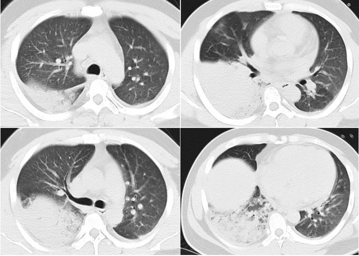 从6个典型案例,看"疑难重症肺部感染"的综合判断和处理!