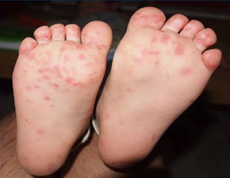 健康嵩明丨预防手足口病,从讲究卫生开始!