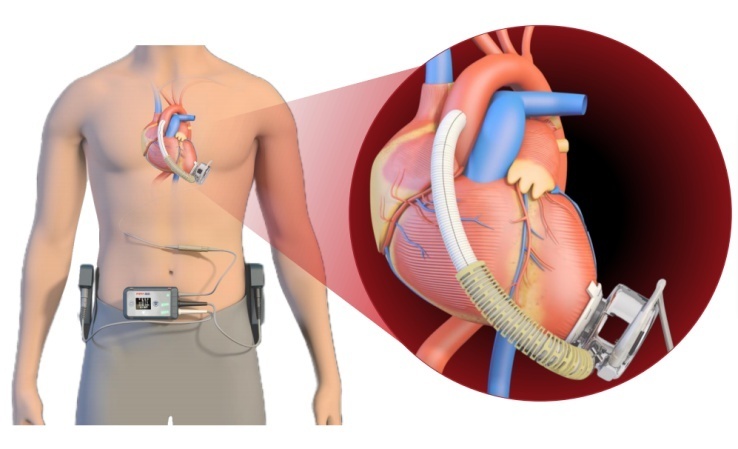 是一种用于治疗严重心力衰竭的机械泵,以暂时或永久地代替心脏的部分