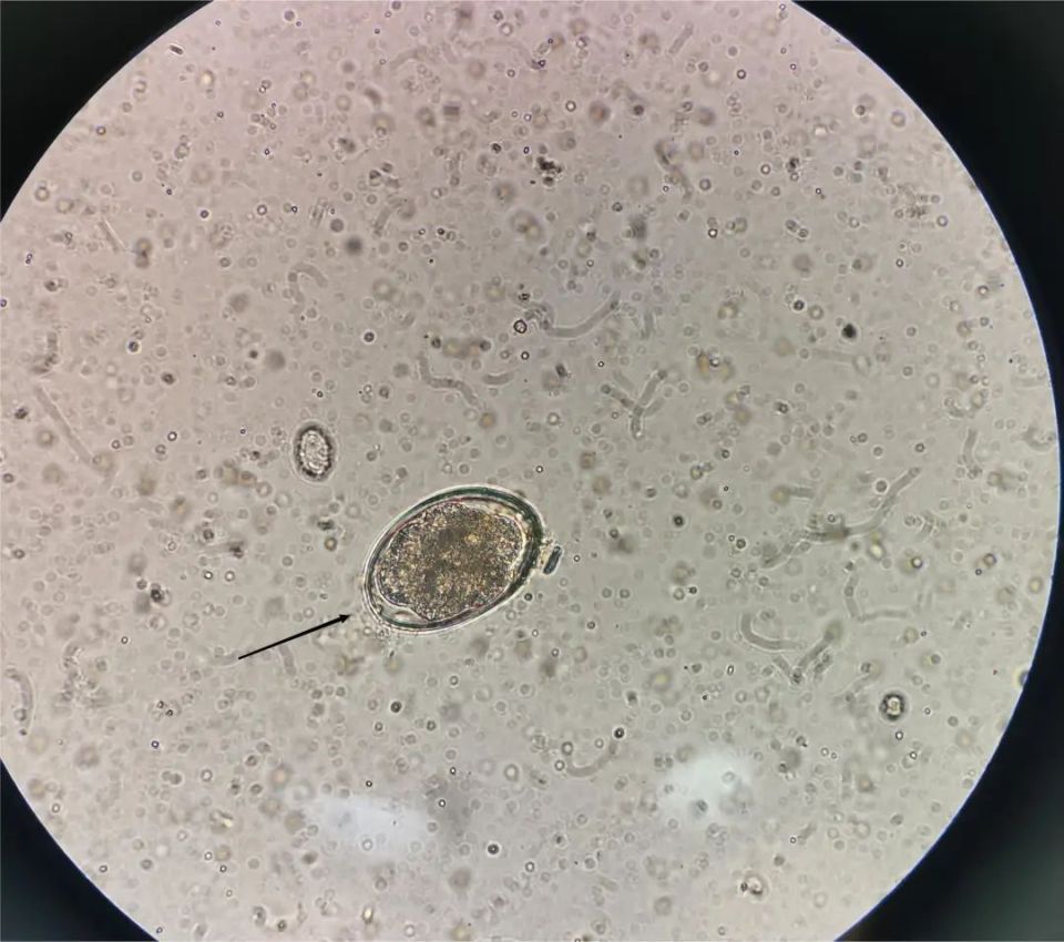 图4 含4-8个卵细胞的钩虫卵 ×400图5 多卵细胞期钩虫卵 ×400图6