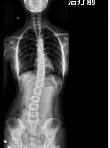 预告丨广东省第二人民医院云浮医院脊柱侧弯训练营来啦!