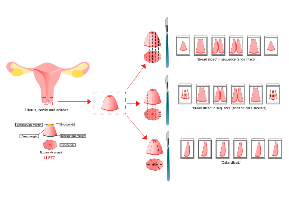 宫颈高级别鳞状上皮内病变，可非手术治疗？_腾讯新闻