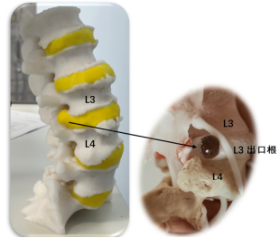 "隐秘的角落"丨反复腰腿疼 全脊柱内镜成功解决极外侧腰椎间盘突出症