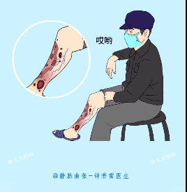 患者问答小腿老烂腿早期症状