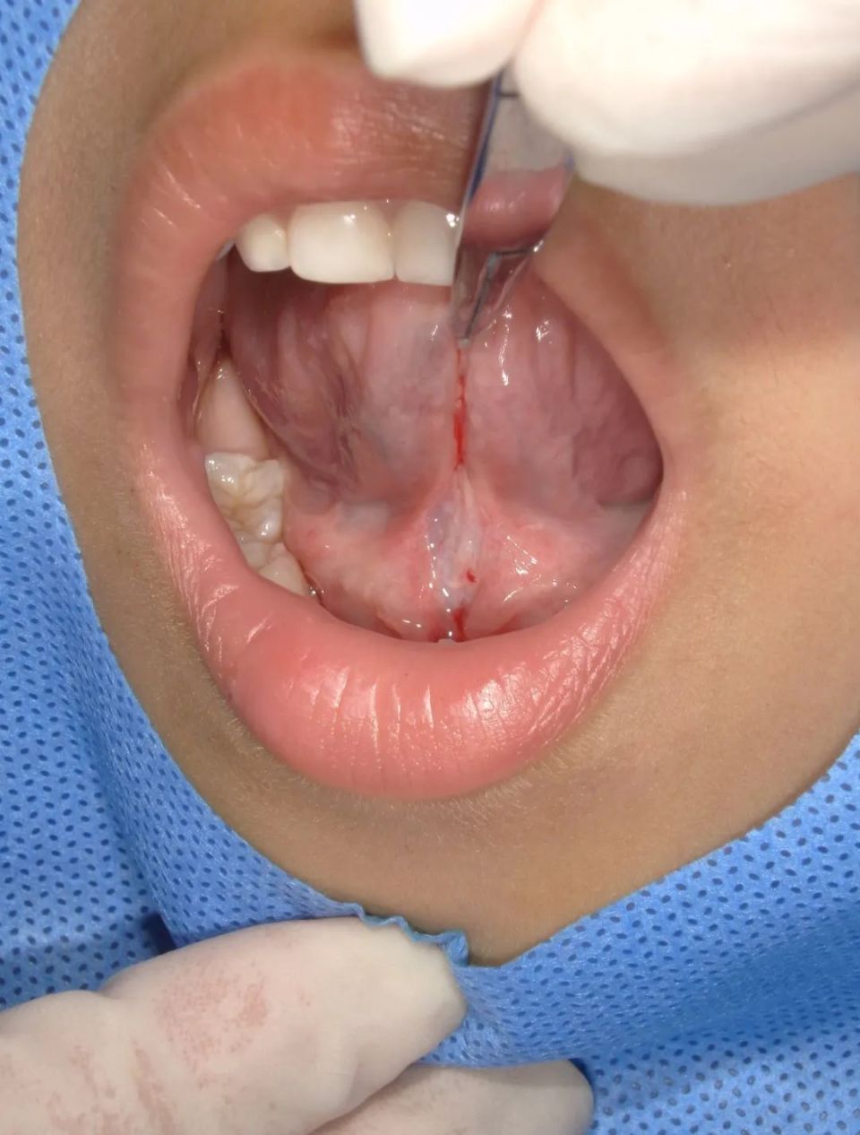 术中剪开,解除舌系带过短引起的软组织牵拉术后缝合完成,避免出血和术