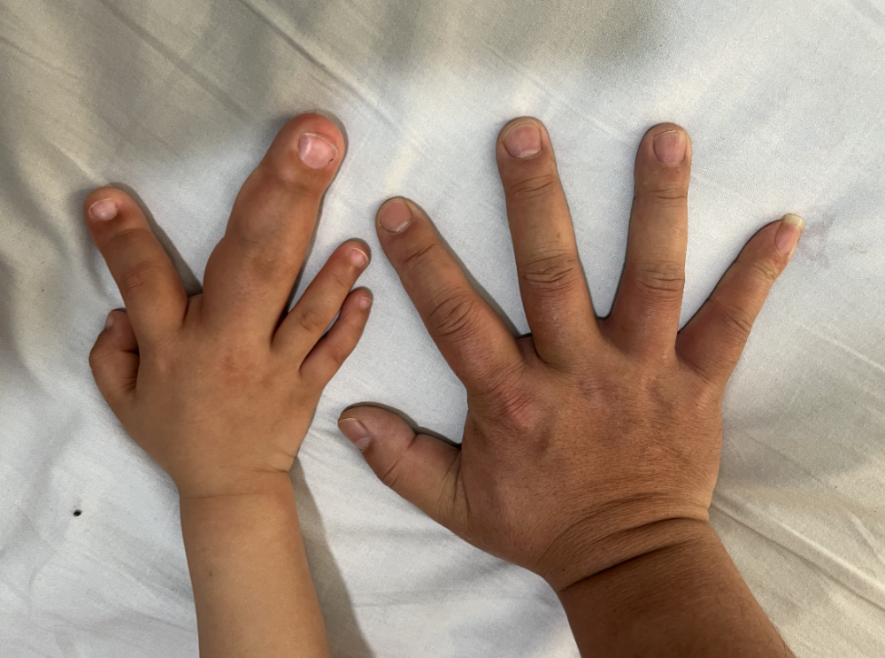 2岁男童手指粗过成年男性医生小手医大手成功修复