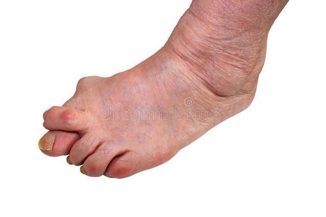 高跟鞋虽美却是拇外翻隐患,常练4招足趾操,与高跟鞋和谐共处_腾讯新闻