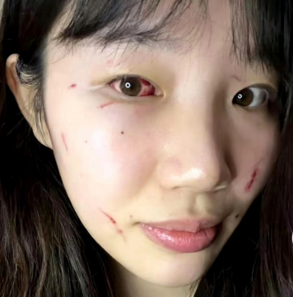 北京女篮对位外援受重伤：鼻骨上颌骨骨折 结膜出血+多处面部伤害
