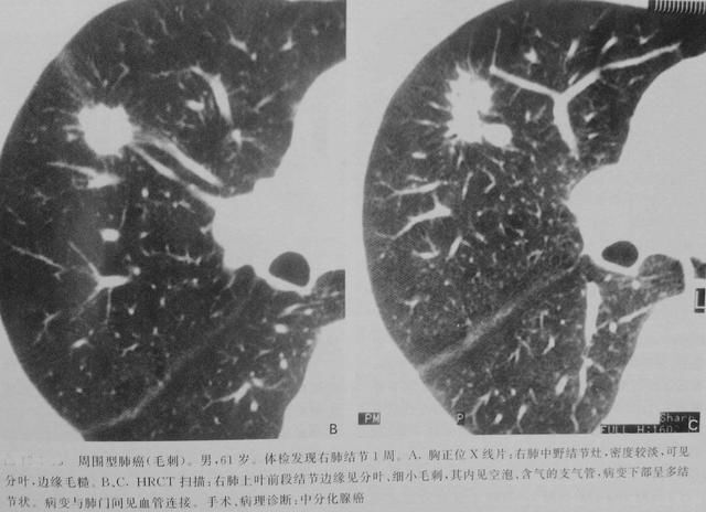 肺部结节有毛刺图片