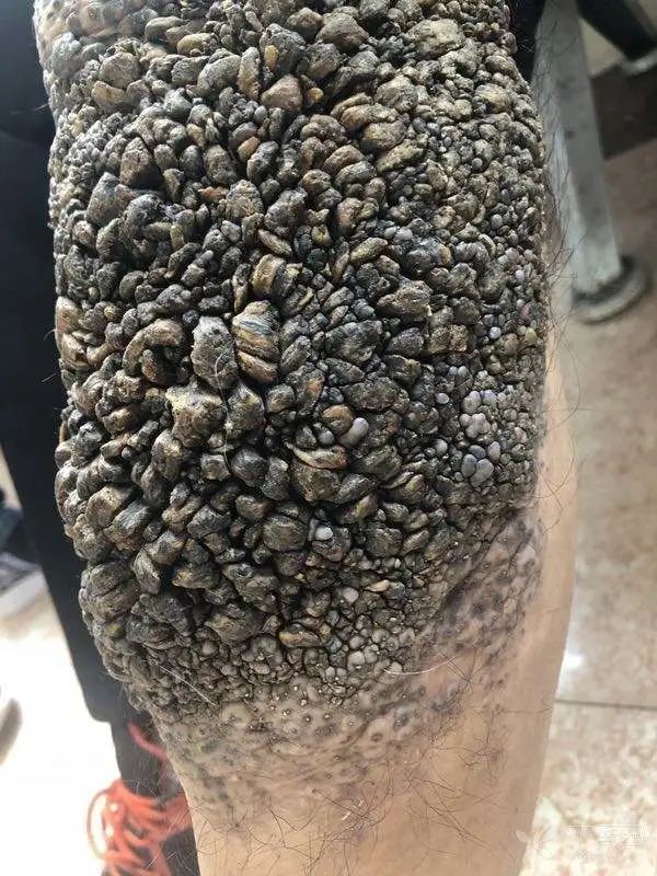 慎入患者腿上长满石子看得我密集恐惧症要犯了