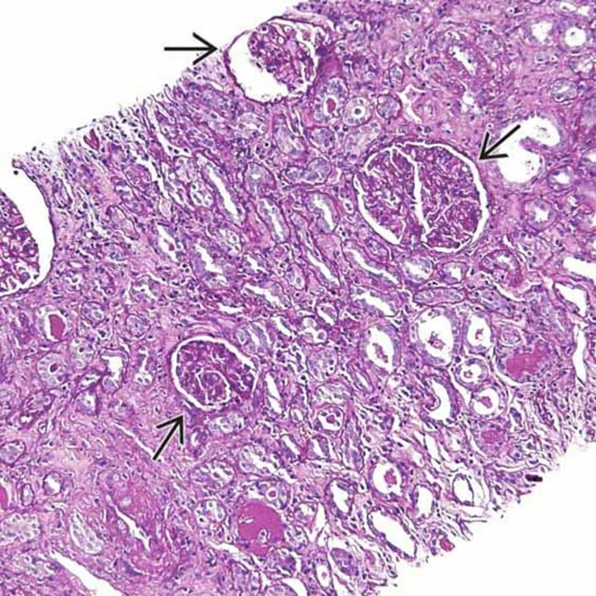 肾脏病理| 结节性多动脉炎