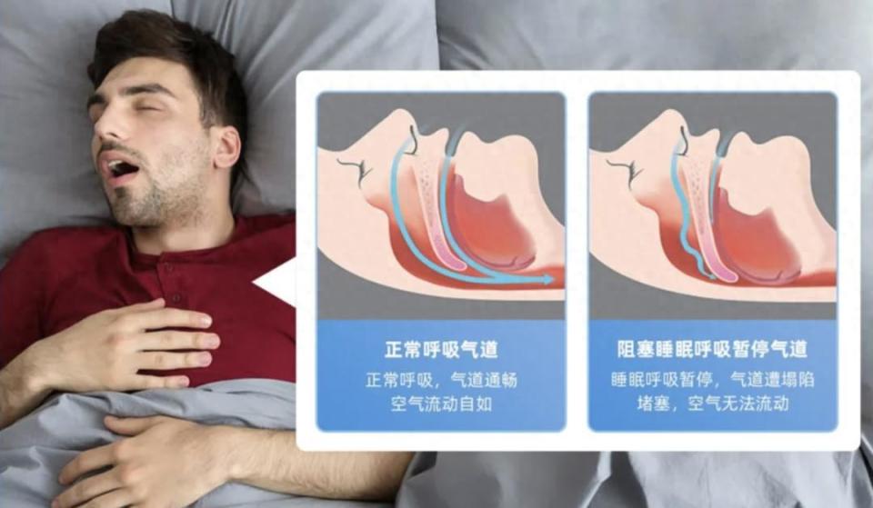 使用呼吸机为什么嗜睡打鼾别大意！阻塞性睡眠呼吸暂停有药物治疗吗？_https://www.jmylbn.com_新闻资讯_第1张