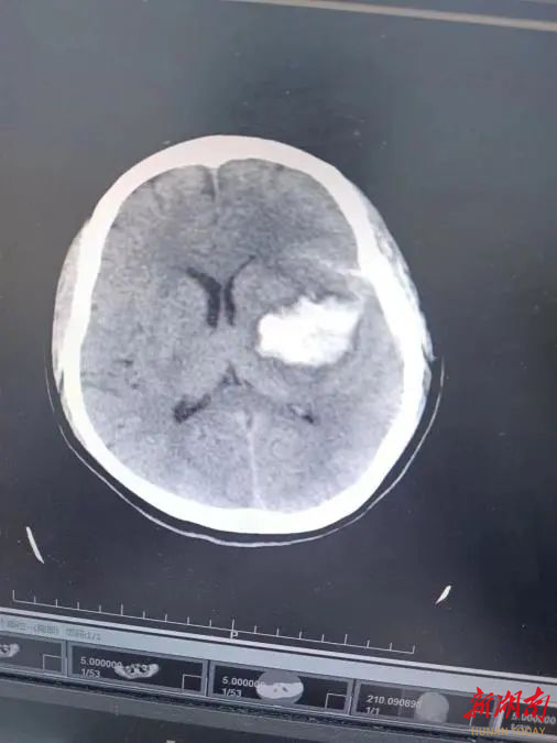 急诊检查发现,孙阿姨血压极高,医生考虑脑血管意外可能,头部ct也提示"