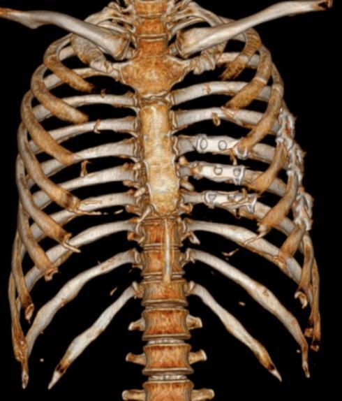 男子不幸车祸肋骨骨折,医生仅开一个4cm小切口就搞定