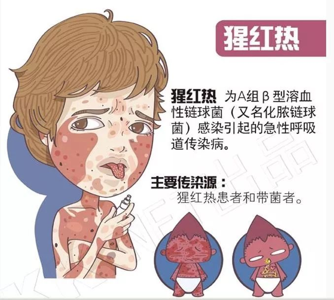 猩红热占领"舞台"后,首先带来咽痛症状作为"开场白",同时可能导致咽部