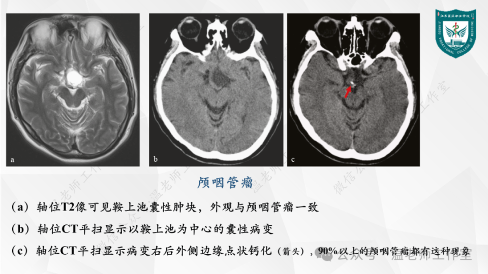 中枢神经系统的病例影像:脑肿瘤