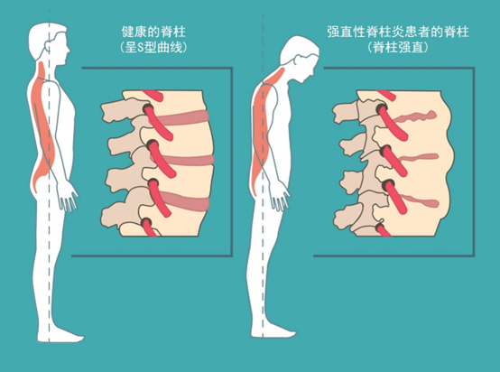 强直性脊柱炎中期图片图片