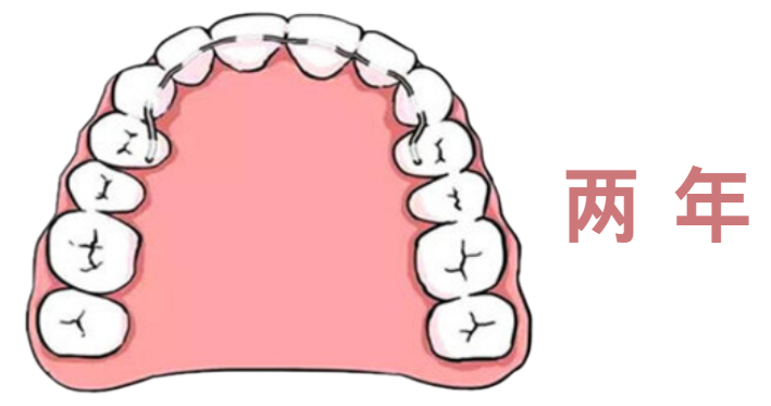 通常正畸医生会建议患者结束矫正后至少需要佩戴两年保持器,第一年