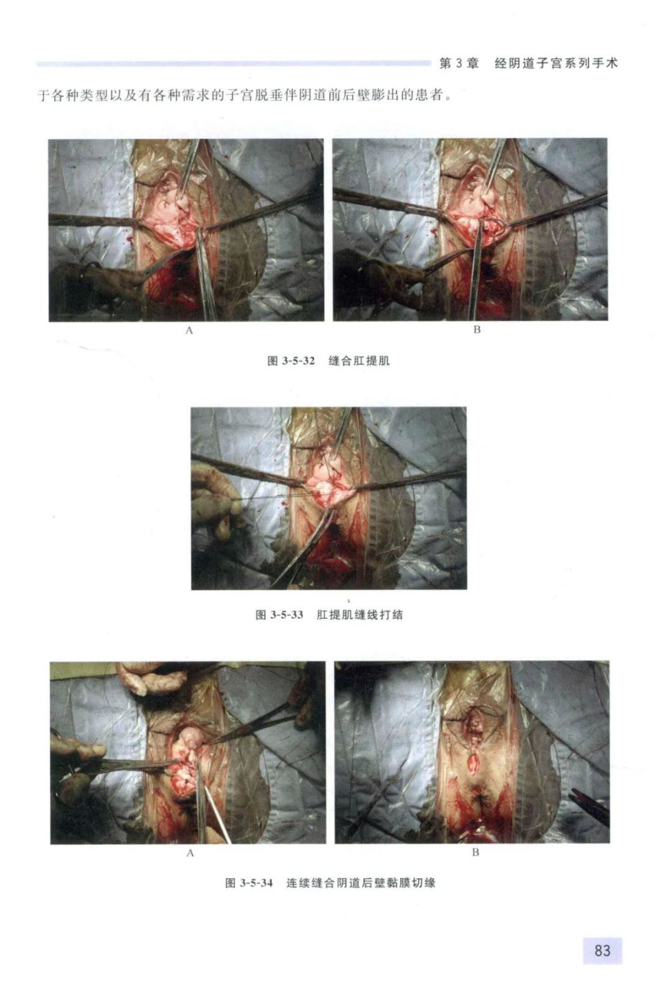 女性前壁膨出手术过程图片