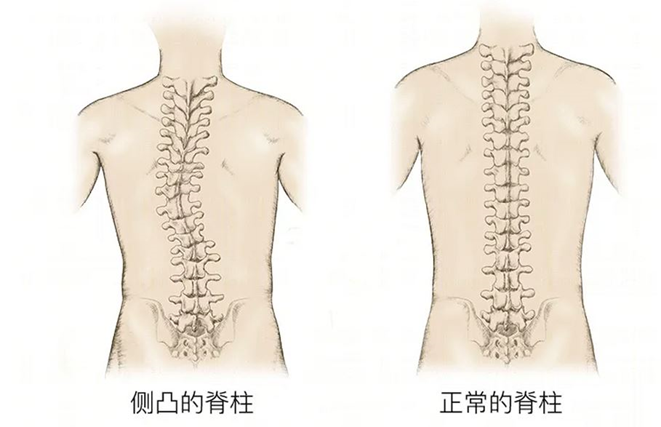 脊柱侧弯,不要担心过度了哟