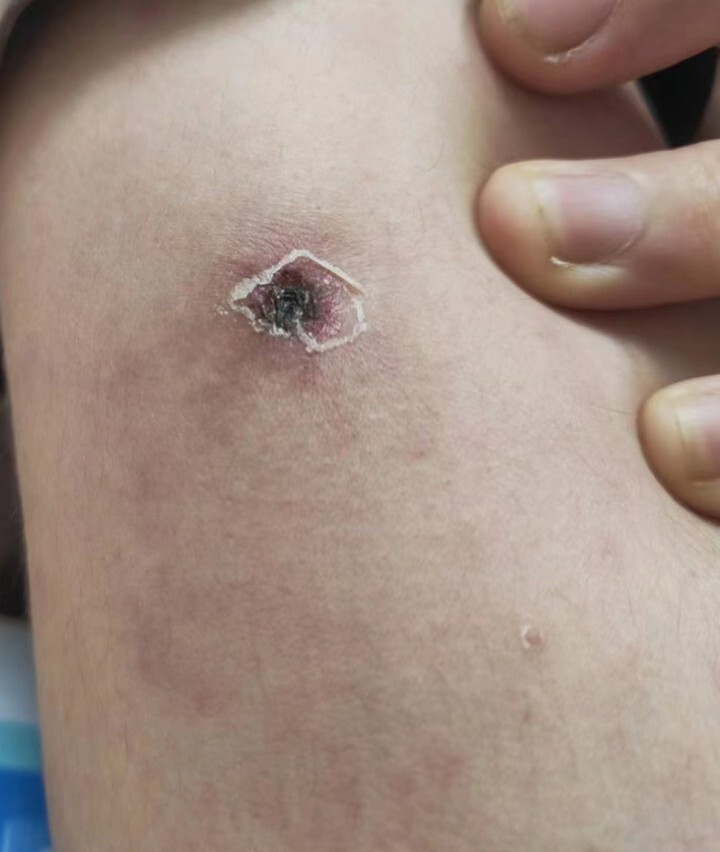 的微生物,主要通过蜱,跳蚤和螨虫等节肢动物叮咬传播给野生动物等宿主