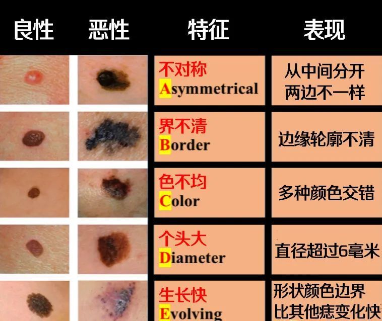 知名歌手因患黑色素瘤去世这样的痣要当心