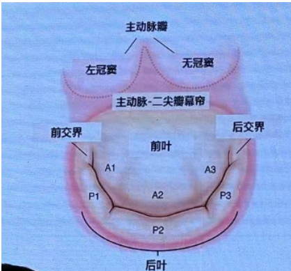 二尖瓣前叶冗长图片