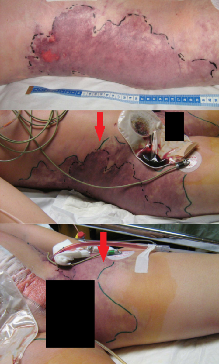 变性术后,近 60% 的体表皮下组织及皮肤被移除,最终死亡……_腾讯新闻