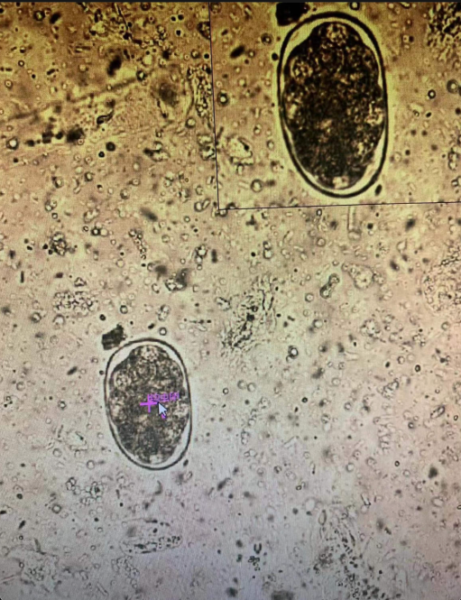 罕见!一人竟然同时感染两种寄生虫