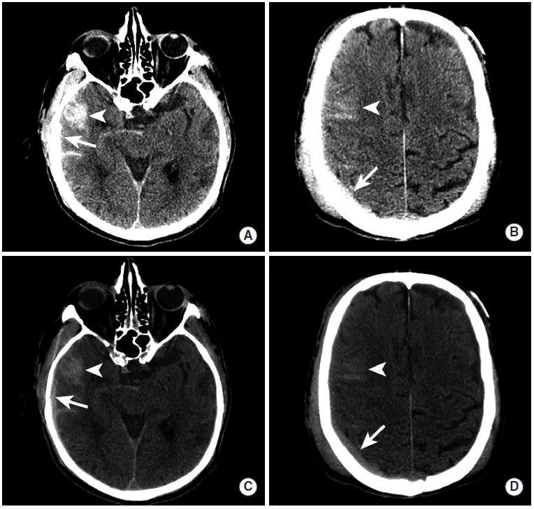 脑出血的ct表现图片图片