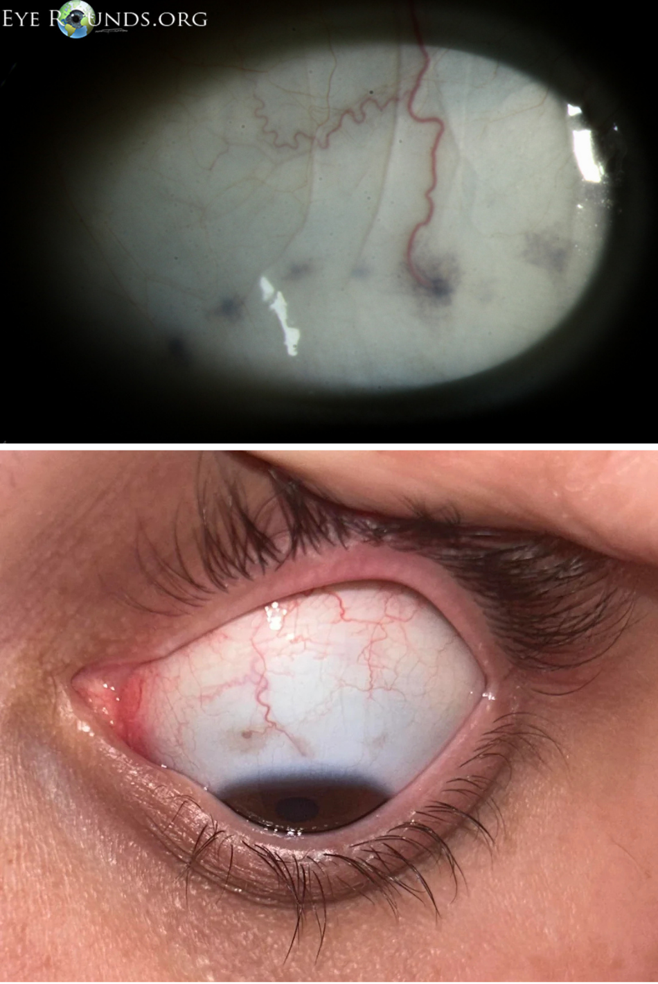 眼白有个小黑点,正常吗?有这些特点要当心