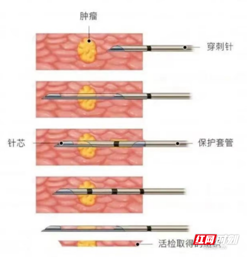 肺穿刺活检针图片图片