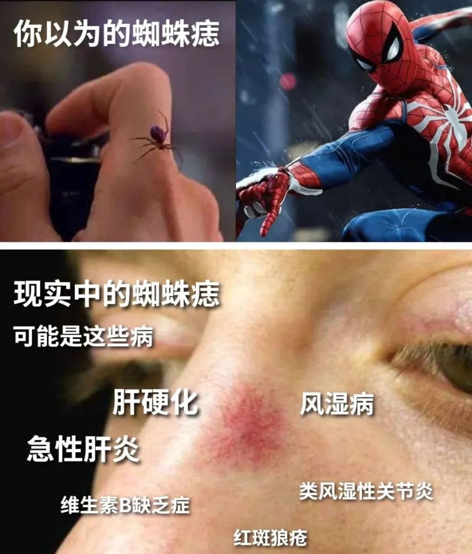 发现他患上了原发性肝癌(肝细胞肝癌)合并慢性乙型病毒性肝炎