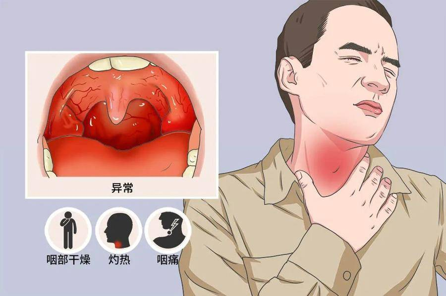 慢性肥厚性咽炎 腾讯网