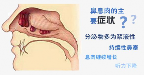 上海仁树眼耳鼻喉门诊部医生:鼻息肉的危害不容小觑