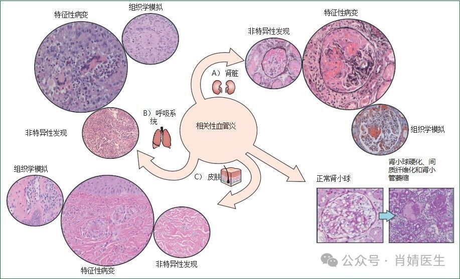临床实践|柳叶刀重磅综述：ANCA相关性血管炎的诊断与治疗_腾讯新闻