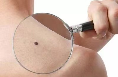 "痣"之不理,还是专心"治痣"