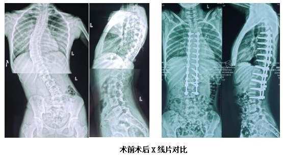 少儿脊柱侧凸手术图图片