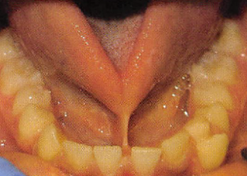 宝宝舌系带短,什么时候剪最好?_腾讯新闻