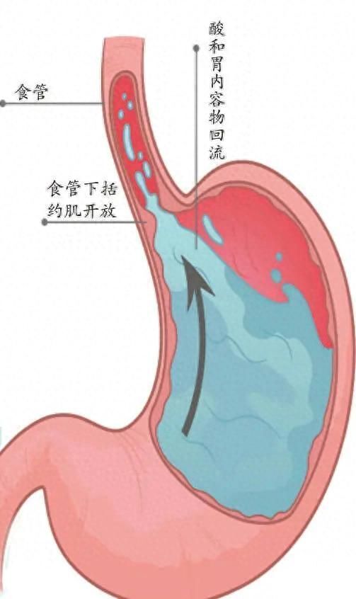 胃食管反流病思维导图图片