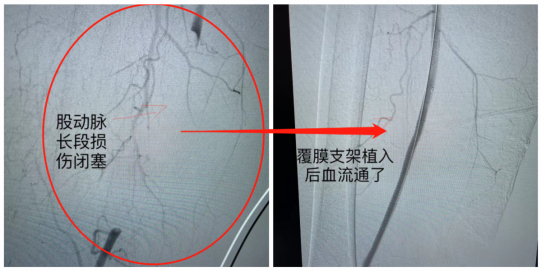 凌晨緊急股動脈取栓手術,患者的腿保住了_騰訊新聞