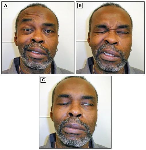 一文了解：成人Bell麻痹的发病机制、临床特征和诊断_腾讯新闻