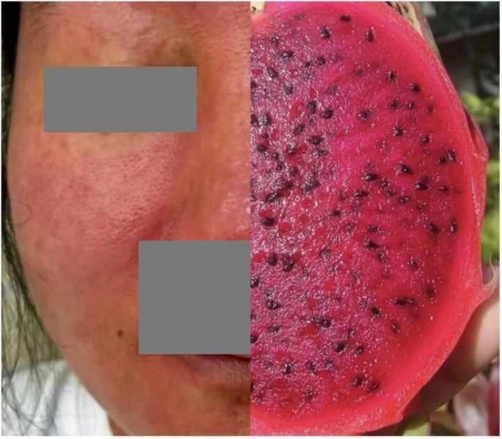 惊呆女子全身皮肤红得发紫犹如火龙果元凶竟是花20块钱买的