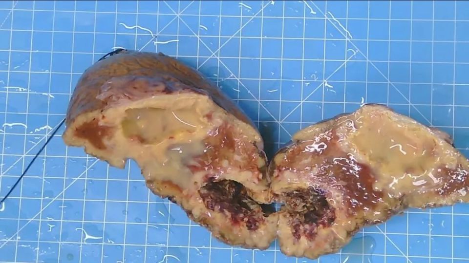 这种病被称为"虫癌"!幼虫主要寄生于肝脏