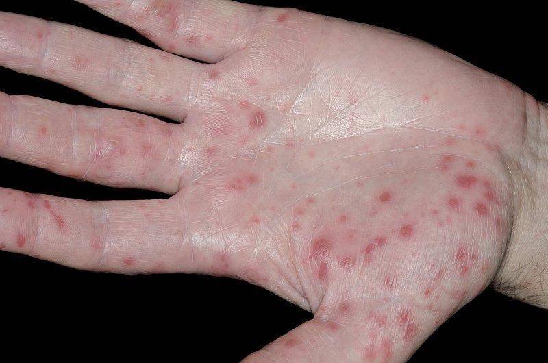 重症手足口病会暴发?打疫苗还有用吗?江苏疾控回应热点