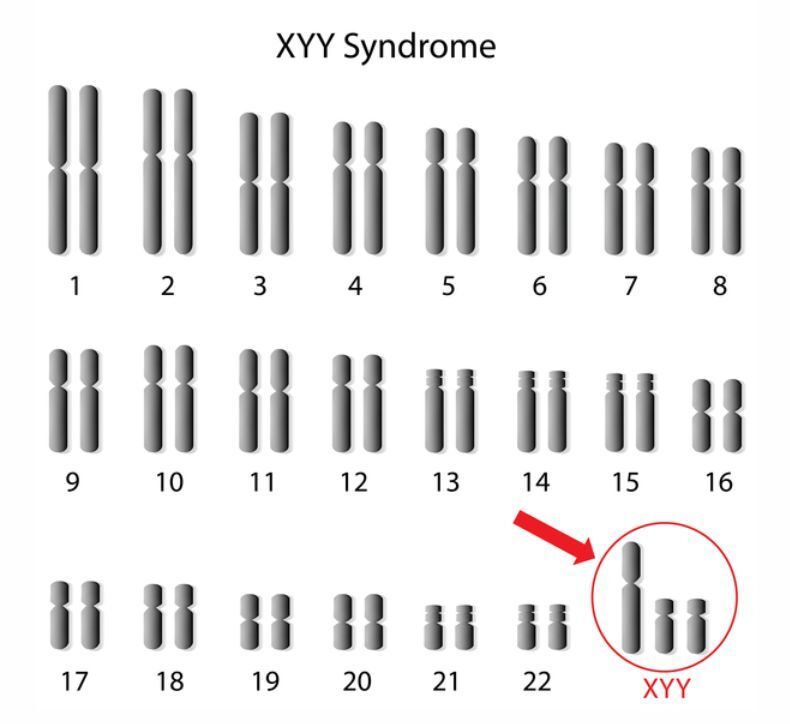 受精卵早期卵裂过程发生部分染色体不分离,导致嵌合体,即一部分细胞的